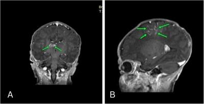 A case report of IPEX syndrome in Palestine: detailed family identification and breadth of disorders with the same defect